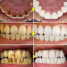 Stylo blanchissant pour les dents - SnowTooth | 1 acheté, 2 offerts | Veiggara